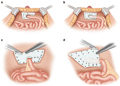 What about enterostomy prolapse?